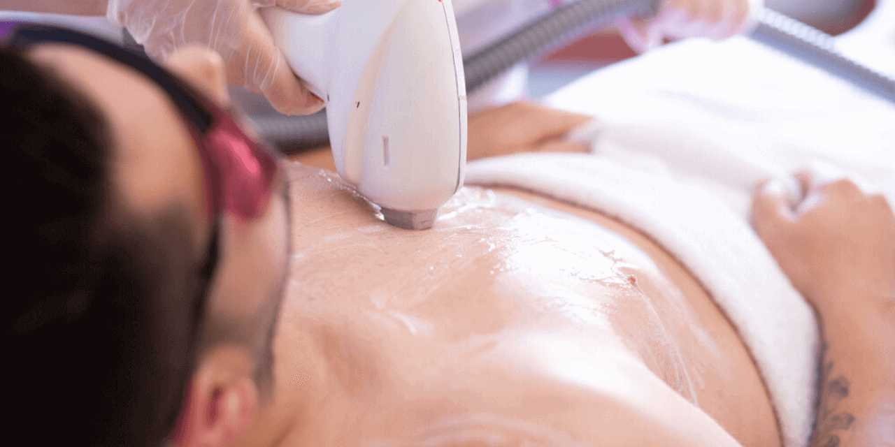 depilación láser para hombres en Sevilla