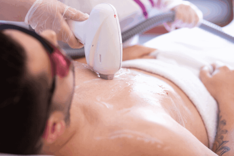 depilación láser para hombres en Sevilla