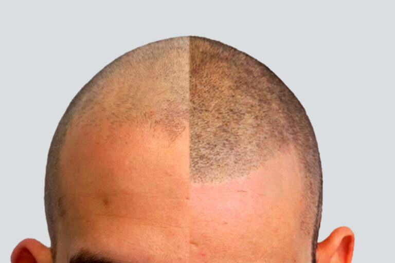 micropigmentación capilar en sevilla barato