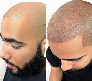 micropigmentación capilar hombre