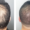 micropigmentación capilar hombre en Sevilla