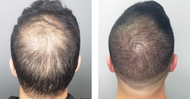 micropigmentación capilar hombre en Sevilla micropigmentación capilar hombre en Sevilla