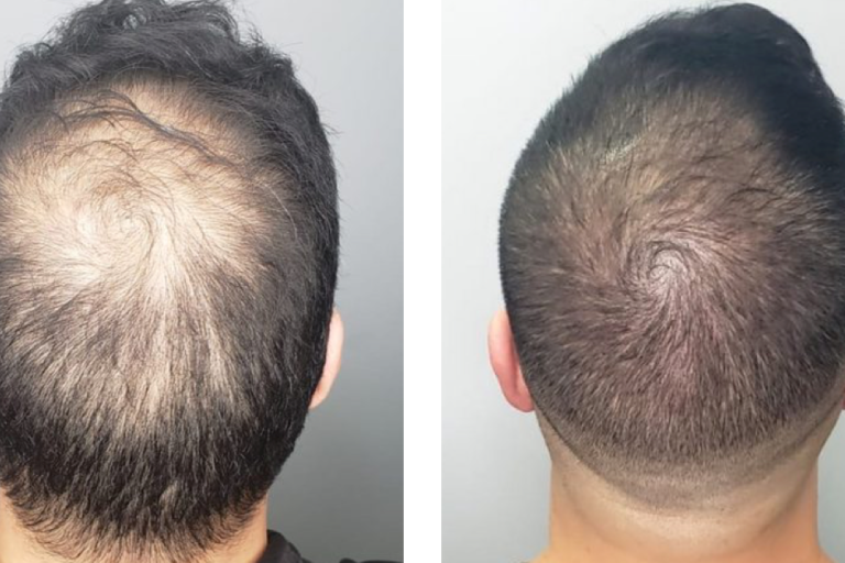 micropigmentación capilar hombre en Sevilla