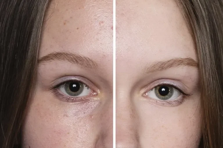 Limpieza manual con extracción de puntos negros y comedones