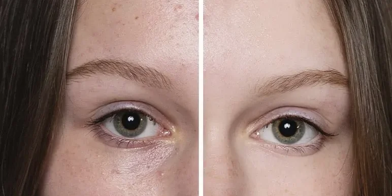 Limpieza manual con extracción de puntos negros y comedones