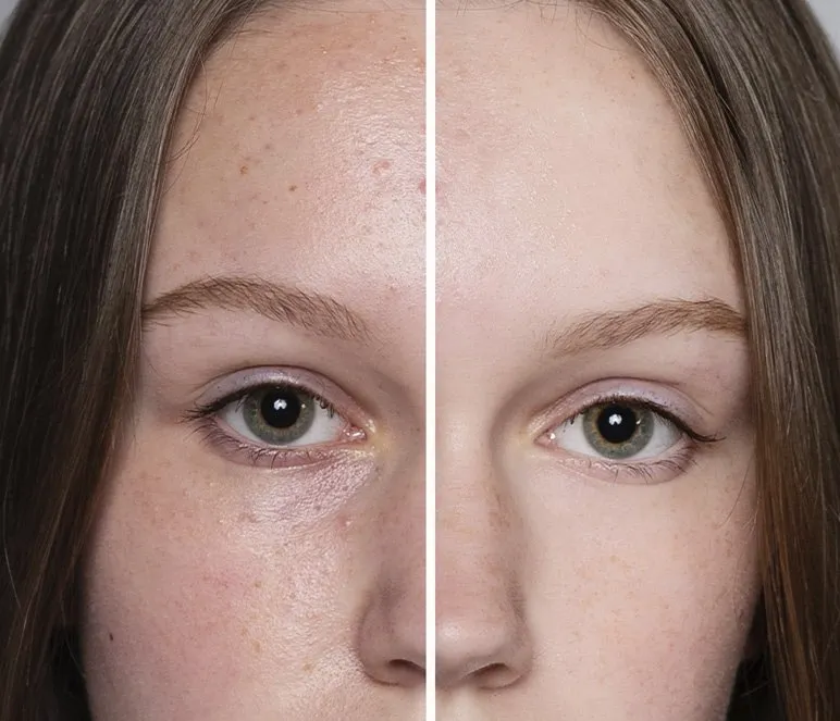 Limpieza manual con extracción de puntos negros y comedones Limpieza manual con extracción de puntos negros y comedones